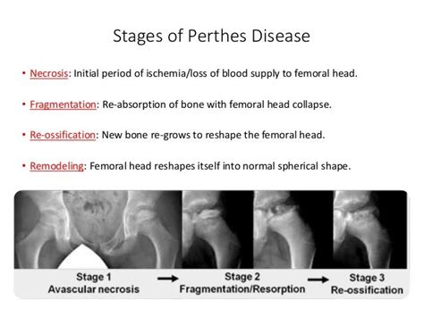 Perthes disease