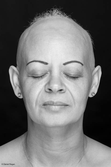 Powerful Photos Of People With Alopecia Prove Bald Is Beautiful