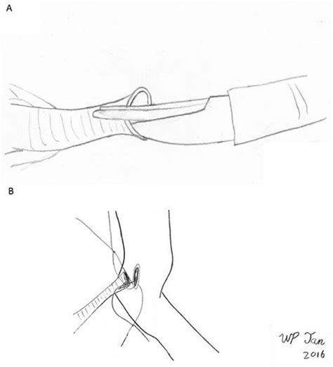 Intentional Omission Of Ureteral Stents During Robotic Assisted