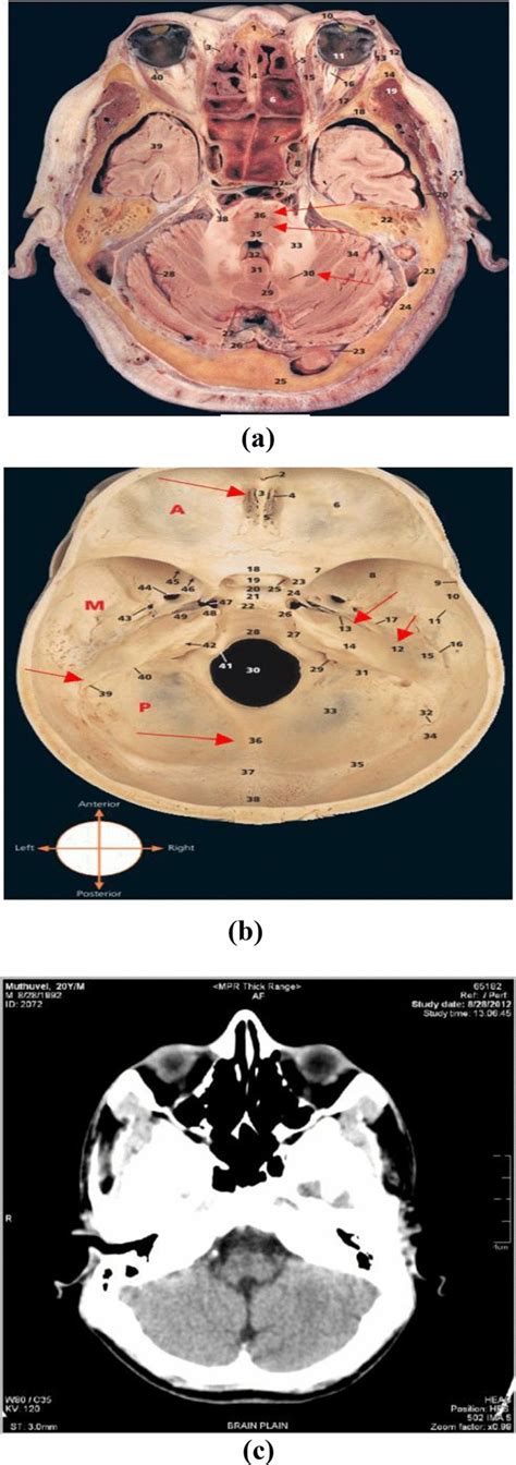 a 30—Dentate nucleus, 35—pontine tegmentum, 36—pontine nuclei. b ...