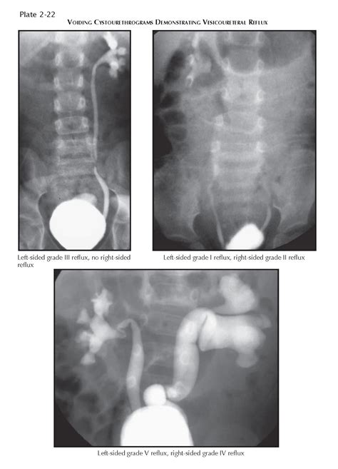 Vesicoureteral Reflux Pediagenosis