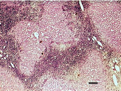 Fine Needle Aspirate Cytology Suggesting Hepatic Lipidosis In Four Cats With Infiltrative