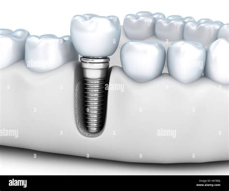 Tooth Human Implant Medically Accurate 3d Illustration White Style