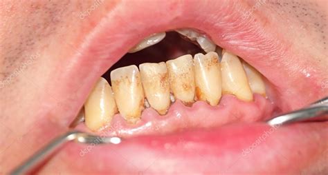 Tartar And Plaque On Frontal Teeth Stock Photo By Drtrig