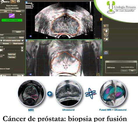 Biopsia De Próstata Por Fusión Urología Peruana Dr Susaníbar