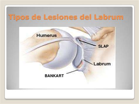 LESIONES DE LABRUM Cirugia De Columna En Matamoros