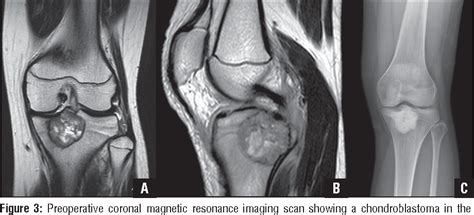 Figure 3 From Proximal Tibia Chondroblastoma Treated With Curettage And