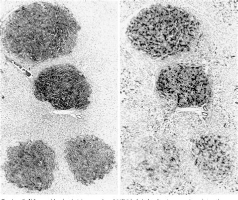 Figure From Placental Glutathione S Transferase Gst P As A New