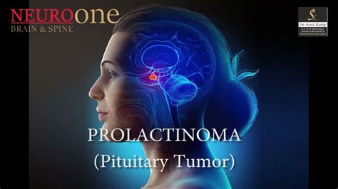 Prolactinoma Youtube