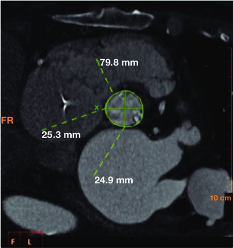 Aortic annulus measurement by CTA. The annulus is defined at the ...