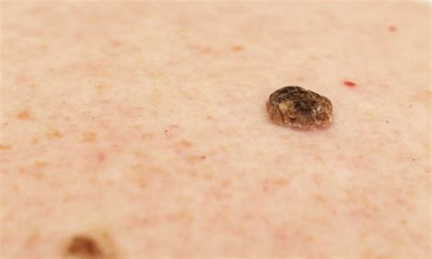 Comprehensive Seborrheic Keratosis Guide Bronx Nyc The Best Porn Website