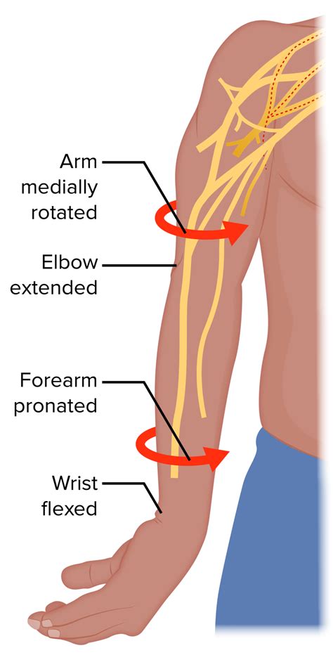 Lesiones Del Plexo Braquial Spotlightmed Spotlight Sexiz Pix Sexiz Pix