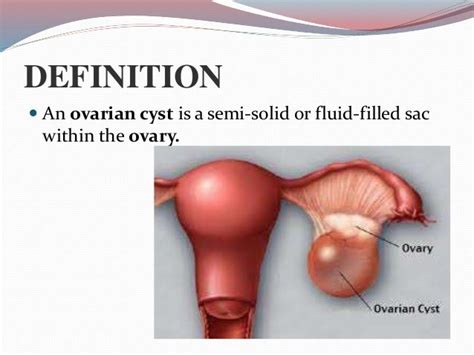 Ovarian Cyst