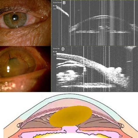 Slit Lamp Magnification And Ubm Magnification Images And A