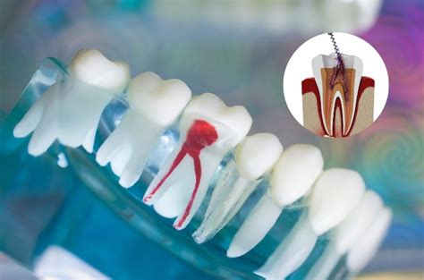 What to Expect During a Root Canal Procedure