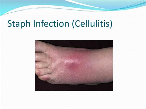 Ppt Minimize Transmission Of Communicable Skin Diseases During Combative Activites Powerpoint