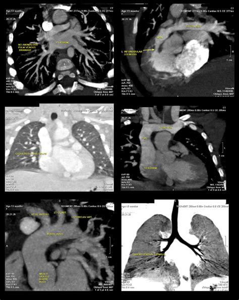 128 Mdct Angiography Of The Heart And Great Vessels Multiple Axial