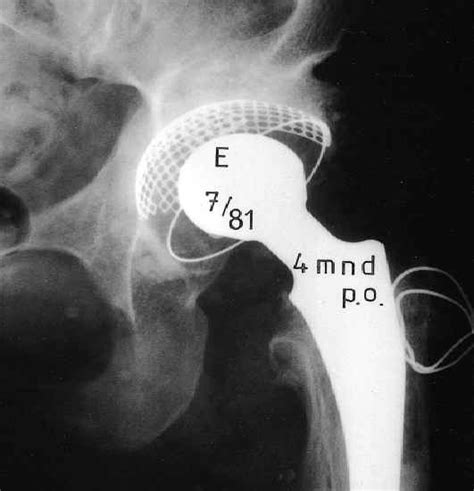 Case Before And After Acetabular Reconstruction Using A Morsellized