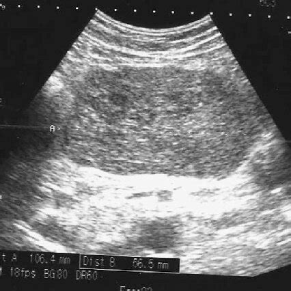 Abdominal ultrasound disclosed hypoechoic, heterogeneous mass filling ...