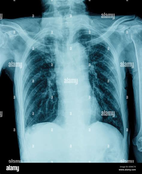 Radiografia Toracica Immagini E Fotografie Stock Ad Alta Risoluzione