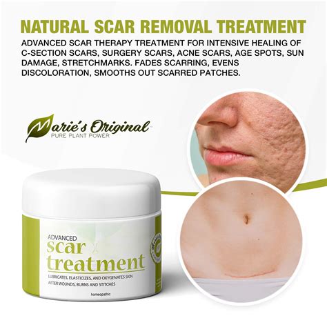 Marie's Original Natural Scar Treatment for Face, Body - Dark Spot Removal Eraser Fading Cream ...