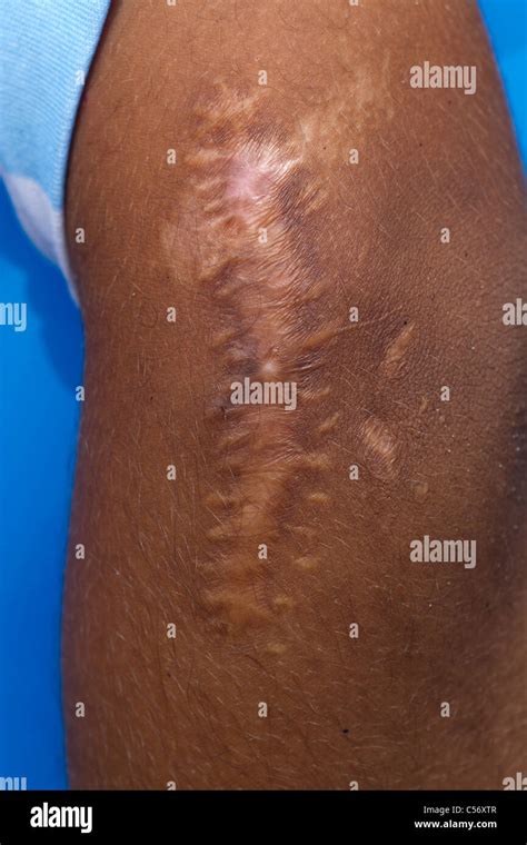 Cicatrice Ipertrofica Immagini E Fotografie Stock Ad Alta Risoluzione