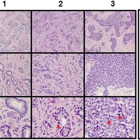 Invasive Ductal Carcinoma Histology