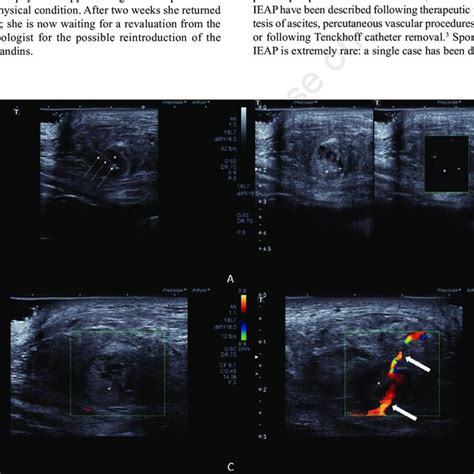 Ultrasound US Guided Percutaneous Embolization Of The Pseudoaneurysm