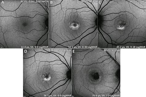 Macular Dystrophies Clinical And Imaging Features Molecular Genetics