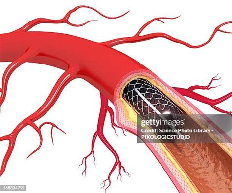 126 Arterial Catheter High Res Illustrations Getty Images