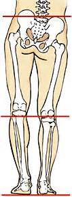 Can One Leg Shorter Than The Other Cause Hip Pain Management