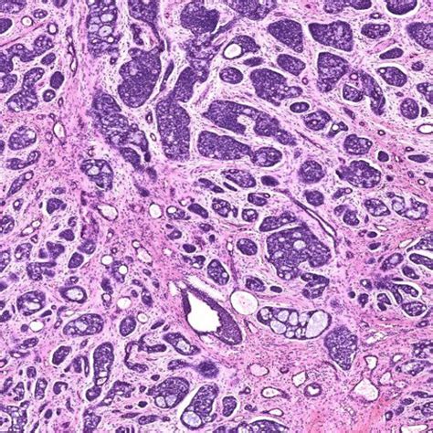 (A) Cribriform pattern with multiple cribriform structures composed of ...