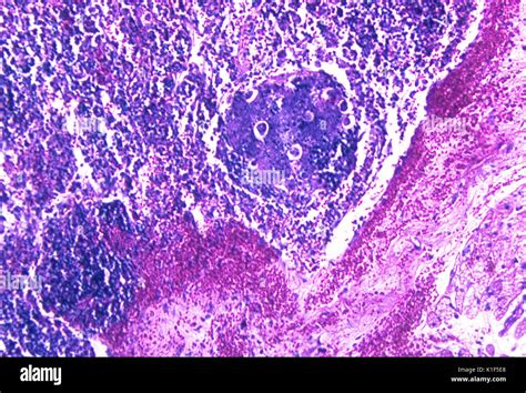 Hemorrhagic Lymph Node Due To Inhalation Anthrax Photomicrograph Of