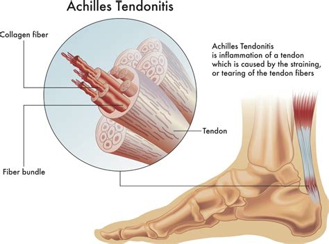 About Achilles Tendonitis Caruso Foot And Ankle