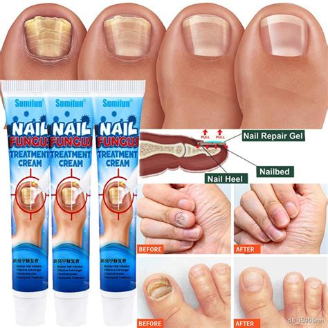 20g Nail Fungus Removal Cream Ointment Onychomycosis Fungal Nail Anti