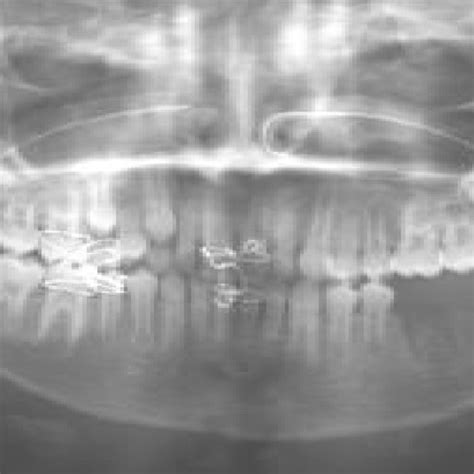 Panoramic Radiograph Showing Multilocular Radiolucent Lesion With Faint