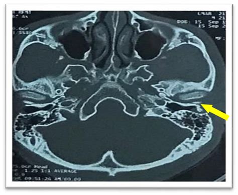 HRCT temporal bone coronal view. | Download Scientific Diagram