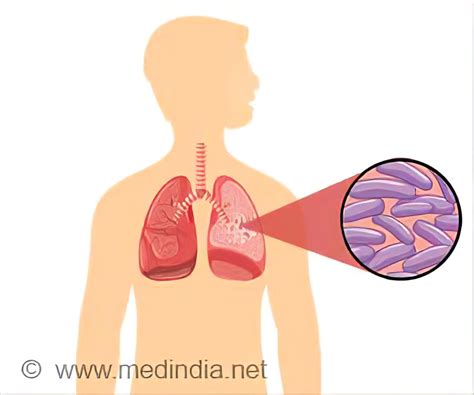 Tuberculosis Spread Symptoms Diagnosis Treatment FAQs