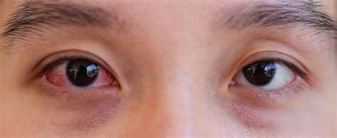 5 Natural Options To Get Relief From Eye Infection