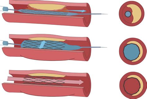 Pta Stent And Atherectomy In Tulsa Ok Restore Blood Flow And Avoid