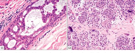 Atypical Apocrine Adenosis Diagnostic Challenges And Pitfalls