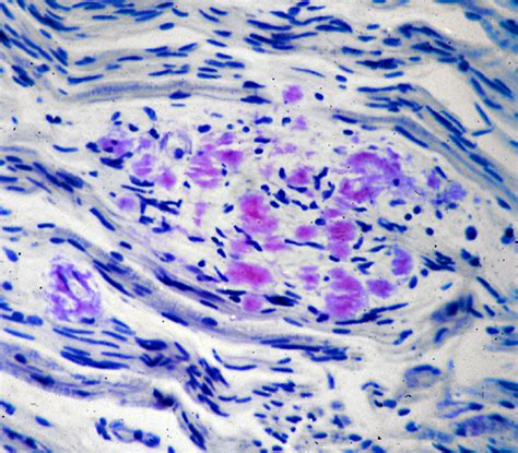 Amyloid Neuropathies, Familial; Familial Amyloid Polyneuropathies