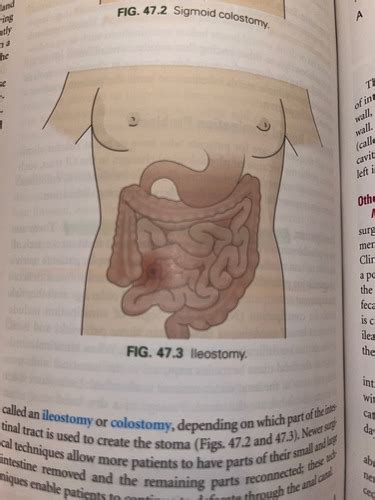 Bowel Elimination Flashcards Quizlet