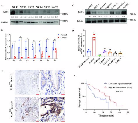 The Expression Pattern And Prognostic Value Of Klf In Pancreatic