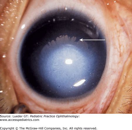 Diseases of the Cornea | Ento Key