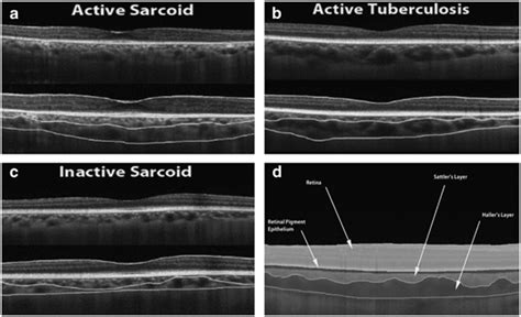 Edi Oct Images Of The Choroid In A Active Sarcoidosis B Active