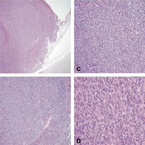 Examples Of Primary Uveal Melanoma H E A Heavily Pigmented