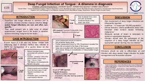 (PDF) Deep Fungal Infection of Tongue : A dilemma in diagnosis