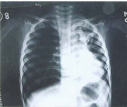 Bronchial cast showing typical branching pattern of left bronchus. | Download Scientific Diagram