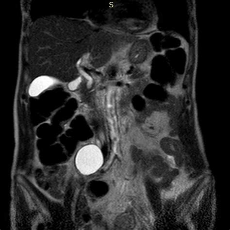 A 58 Years Old Male Patient With Urinary Bladder Cancer Scc Grade Ii